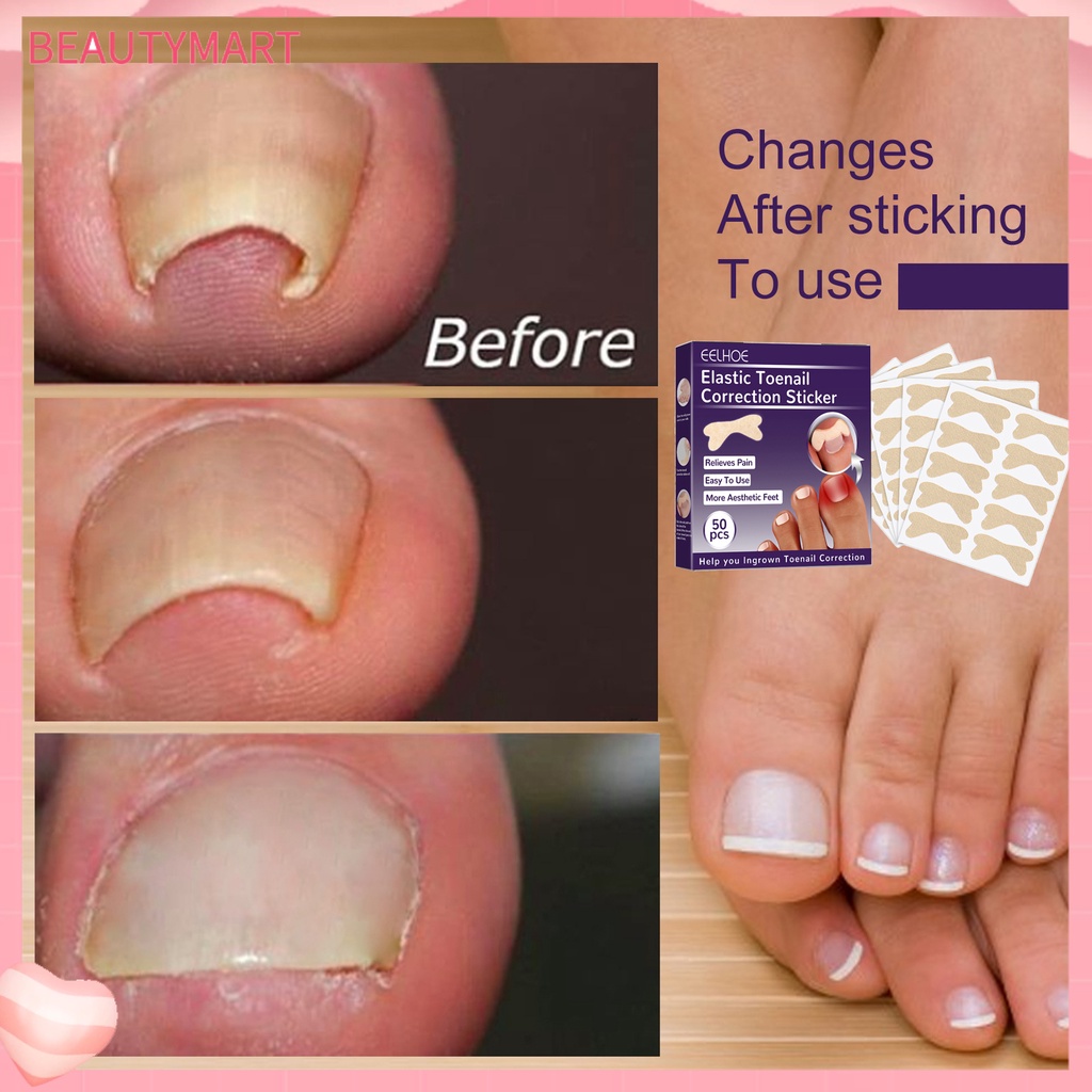Set 50 Miếng Dán Móng Chân Tự Dính Chống Nước Thoáng Khí Chỉnh Sửa Lỗ Chân
