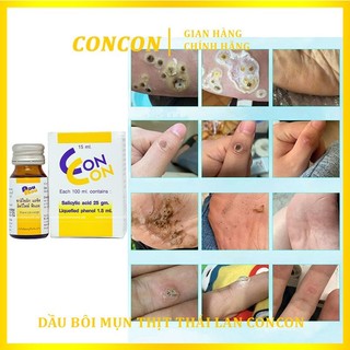 Loại bỏ mụn cóc mụn cơm Con Con Thái Lan