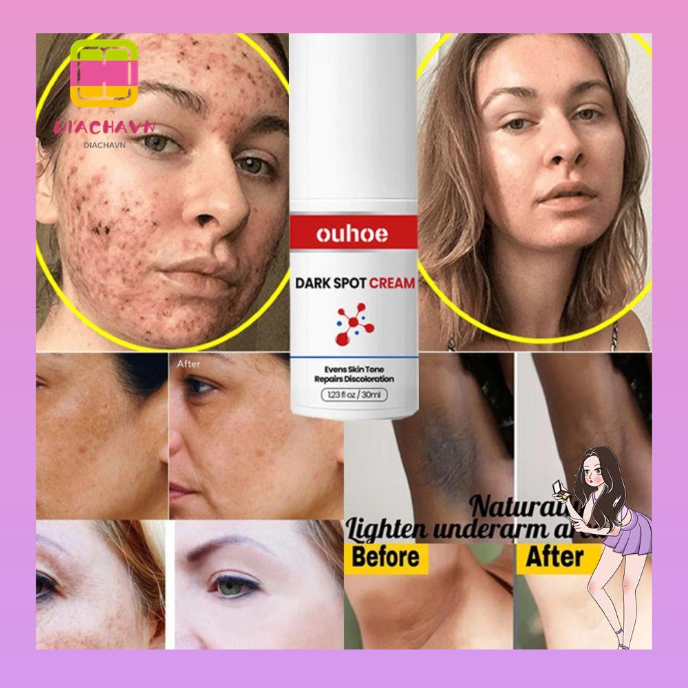 Kem Hỗ Trợ Giảm Tàn Nhang Đốm Đen Làm Sáng Da Hiệu Quả