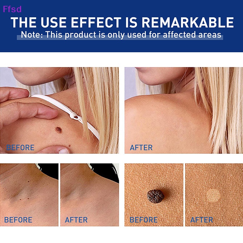 1 Dụng Cụ Kẹp Nhỏ Bằng Đồng Loại Bỏ Mụn Thịt Xăm Hình