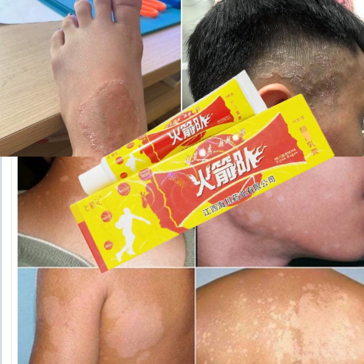 Kem bôi da nấm, ngứa, vảy nến, nứt nẻ, côn trùng muỗi đốt,... - Hàng có sẵn -tranthuy egfrehgtjuyt
