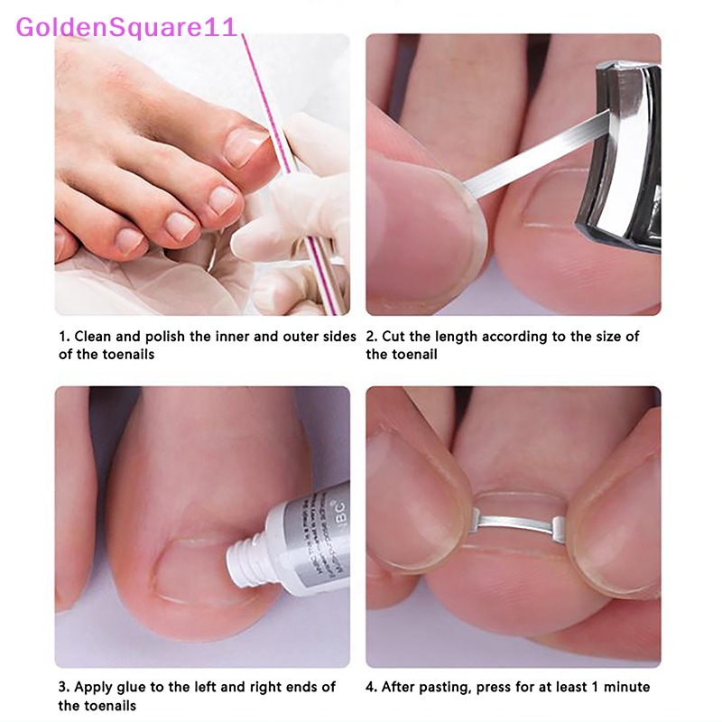 Miếng Dán Điều Chỉnh Móng Chân Mọc Ngược Đàn Hồi