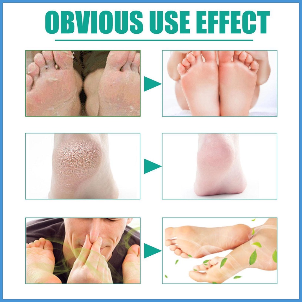 Kem Thảo Dược Tự Nhiên Trị Ngứa Và Mùi Hôi Chân 60ml