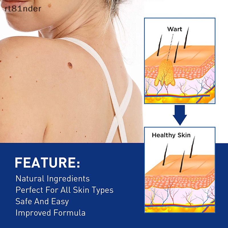 Rt 1 Dụng Cụ Kẹp Nhỏ Bằng Đồng Loại Bỏ Mụn Thịt / Hình Xăm