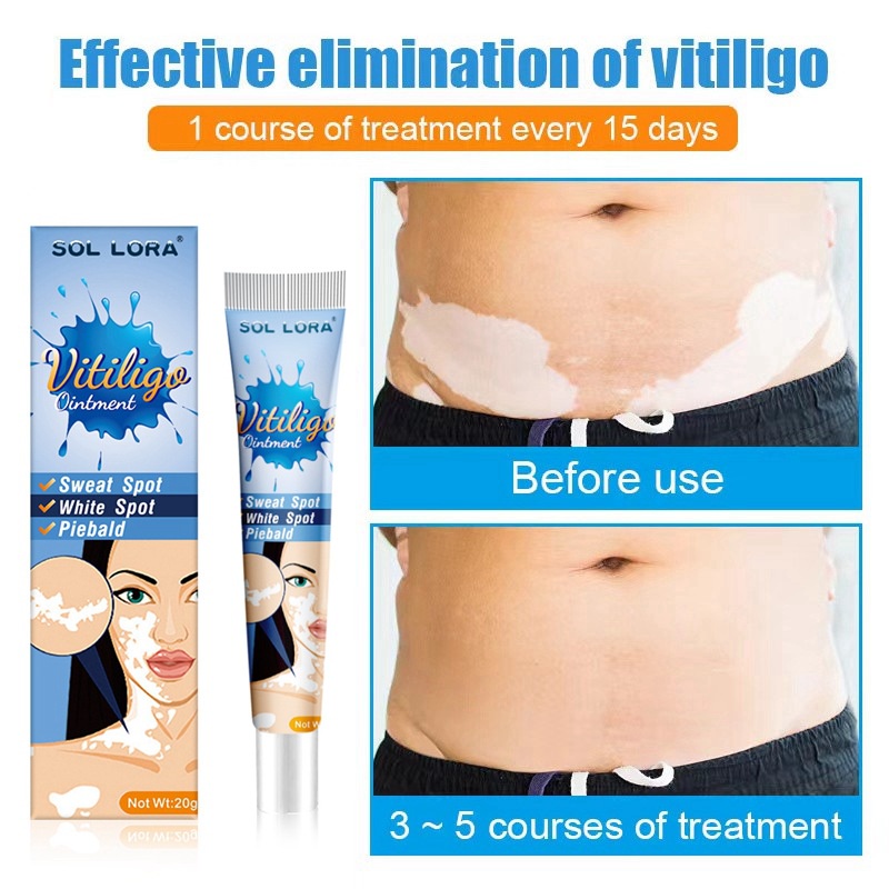 20g loại bỏ đốm trắng da kem điều trị bệnh leukoplakia đốm trắng