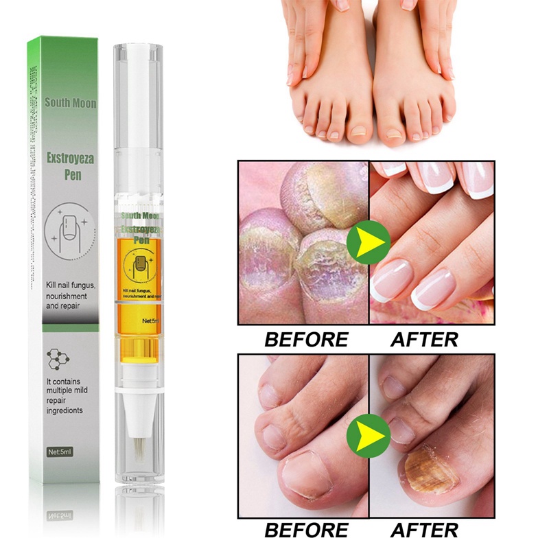 Bút Dung Dịch Trị Nấm Móng 5ml