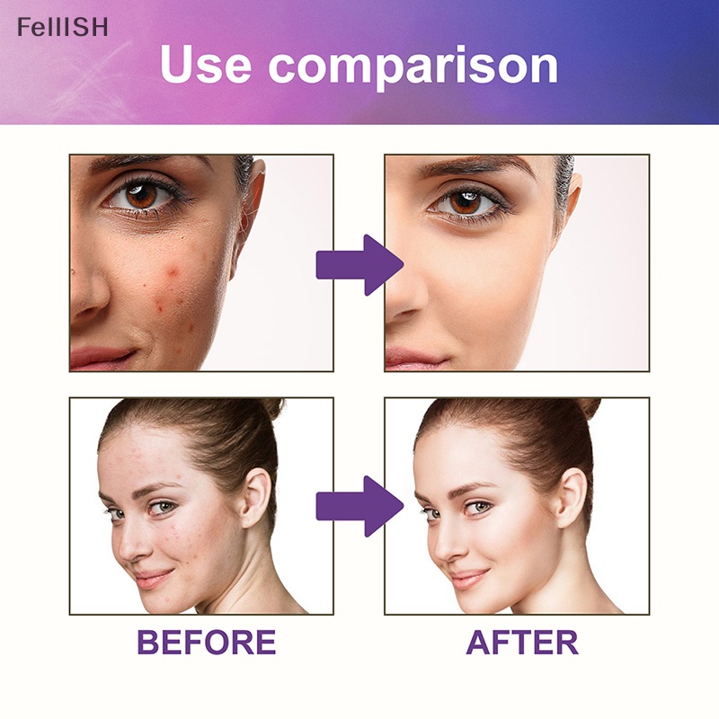 Hộp 144 Miếng Dán Hỗ Trợ Giảm Mụn Kháng Nước Vô Hình 439br