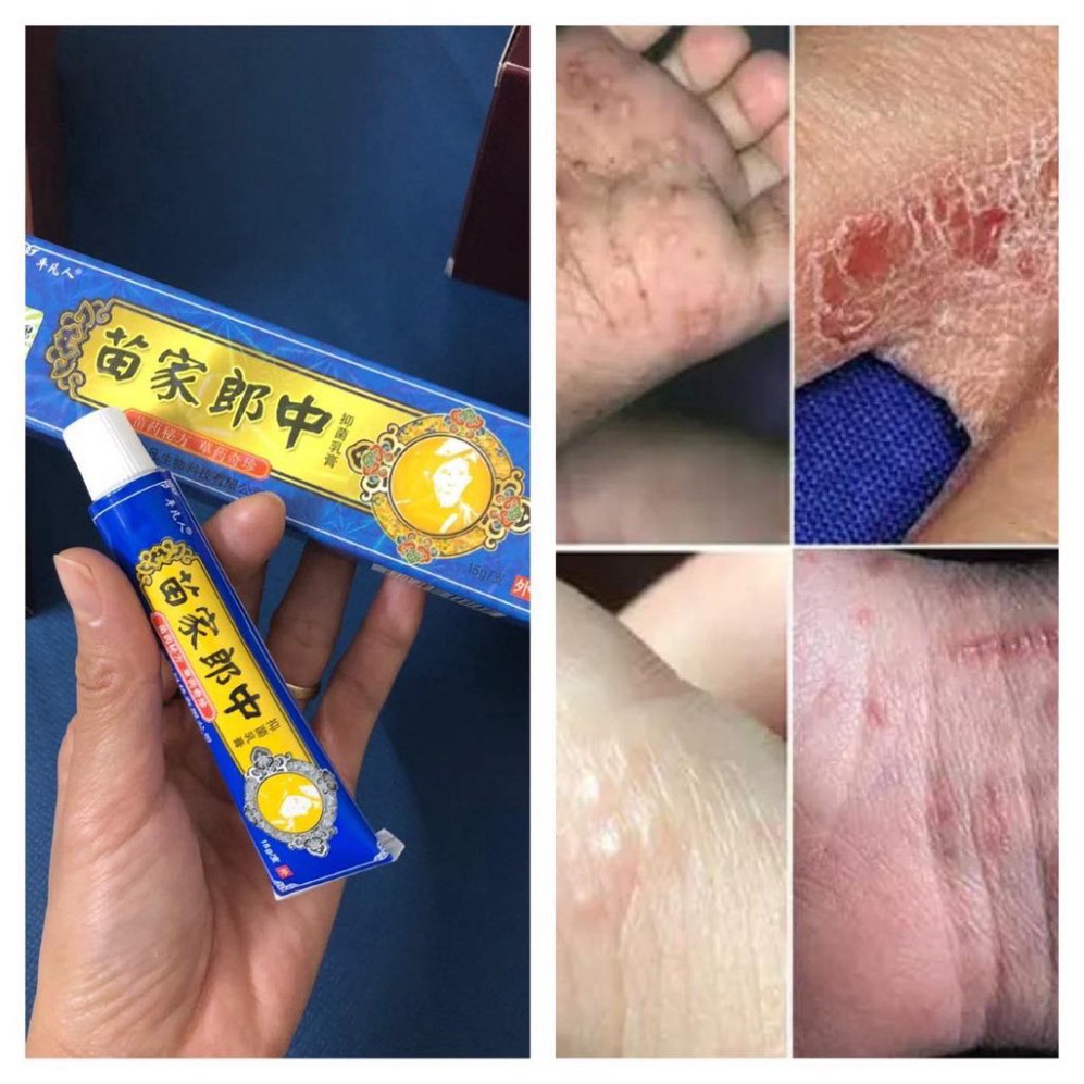 Kem Bôi Đông Y Thảo Dược Nấm Ngứa 15g XANH DƯƠNG