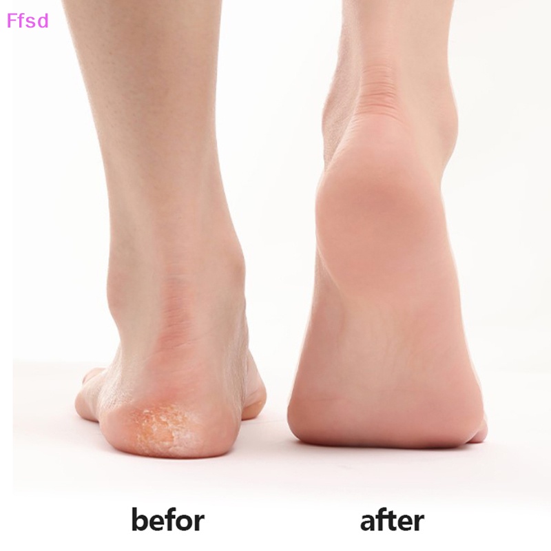 Dụng Cụ Tẩy Vết Chai Chân Bằng Thép Không Gỉ 420