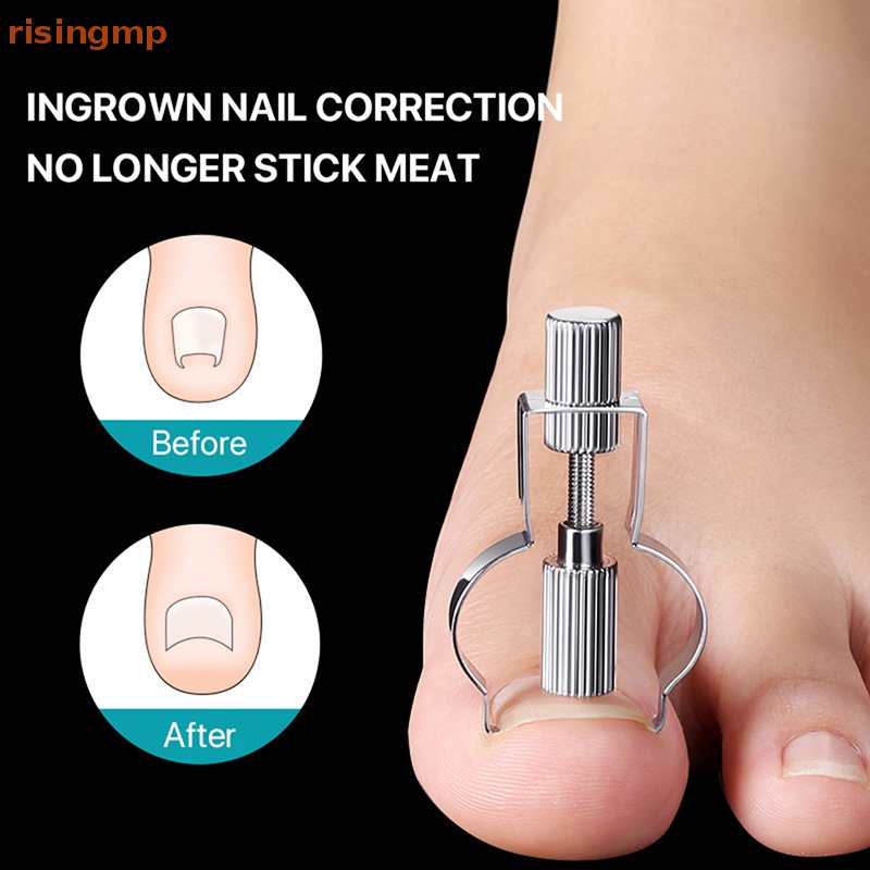 Dụng Cụ Định Hình Móng Chân Mọc Ngược Tiện Dụng