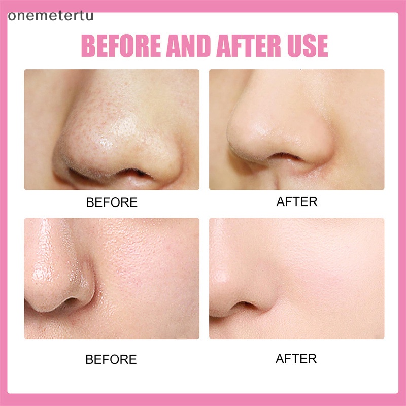 Miếng Dán Lột Mụn Đầu Đen onemetertu Làm Sạch Sâu Lỗ Chân Lông