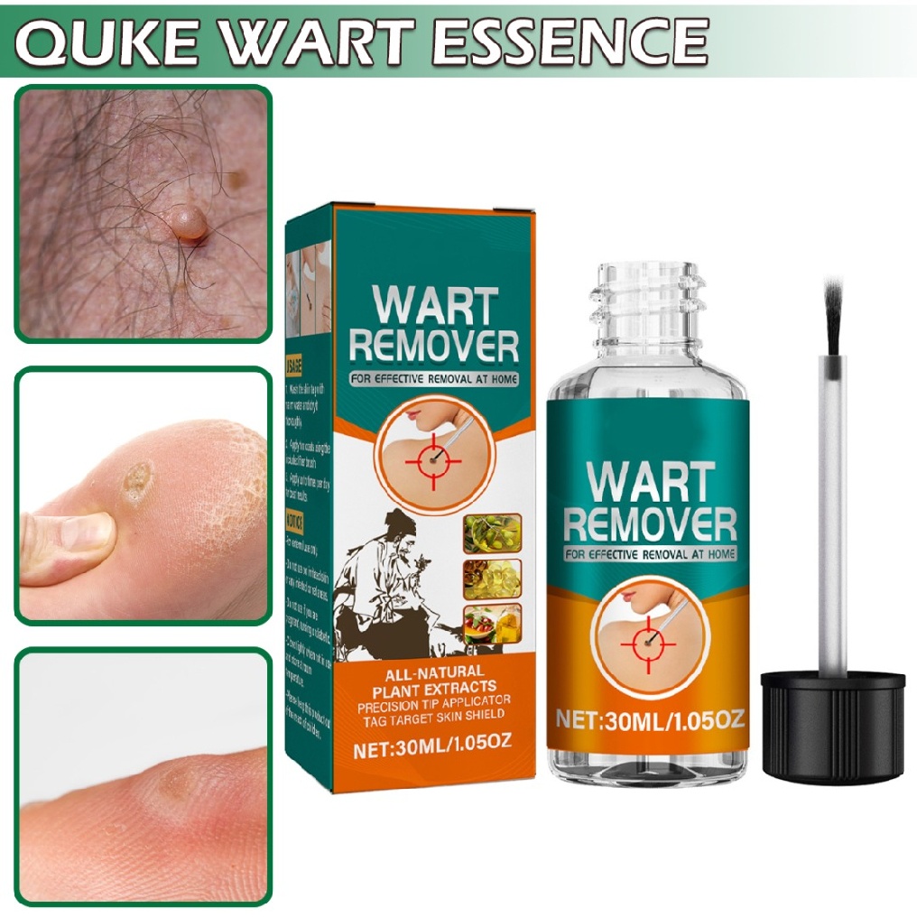 Liquid Wart Remover 30ml Skin Tag Removal Mole Solution Fast Action Serum
