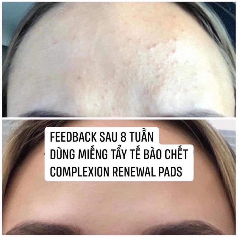 Miếng tẩy tế bào chết Zo Skin Complexion Renewal Pads Pad 30 miếng