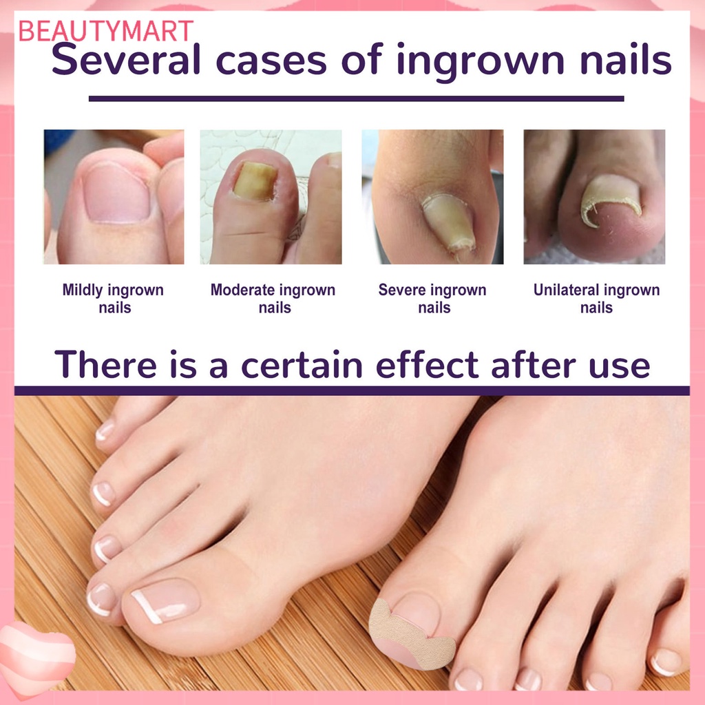 Set 50 Miếng Dán Móng Chân Tự Dính Chống Nước Thoáng Khí Chỉnh Sửa Lỗ Chân