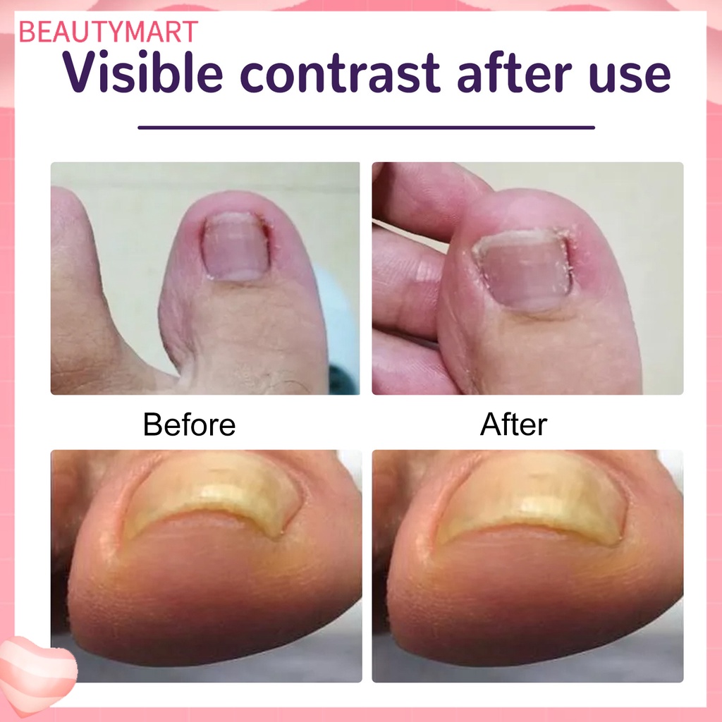 Set 50 Miếng Dán Móng Chân Tự Dính Chống Nước Thoáng Khí Chỉnh Sửa Lỗ Chân