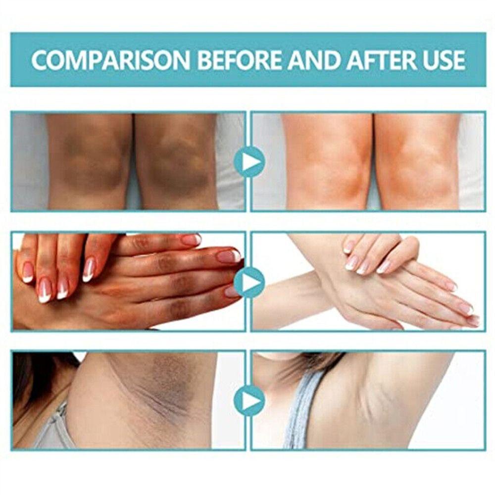 Kem Dưỡng Trắng Da Nigrifree Chứa Thành Phần Nigrifree Acanthosis Giúp Làm Mờ Vết Thâm Hiệu Quả