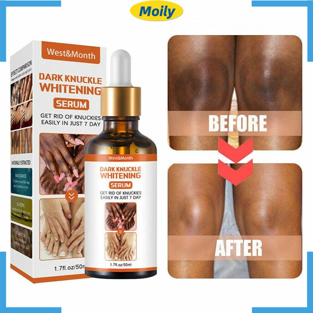 MOILYVN Tinh Chất Dưỡng Ẩm Làm Trắng Chăm Sóc Da Đầu Gối Và Mắt Cá Chân