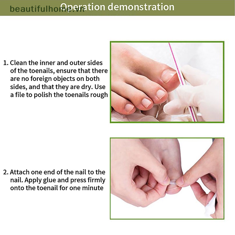 Set 10 Kẹp Cố Định Móng Chân Tiện Dụng Chất Lượng Cao