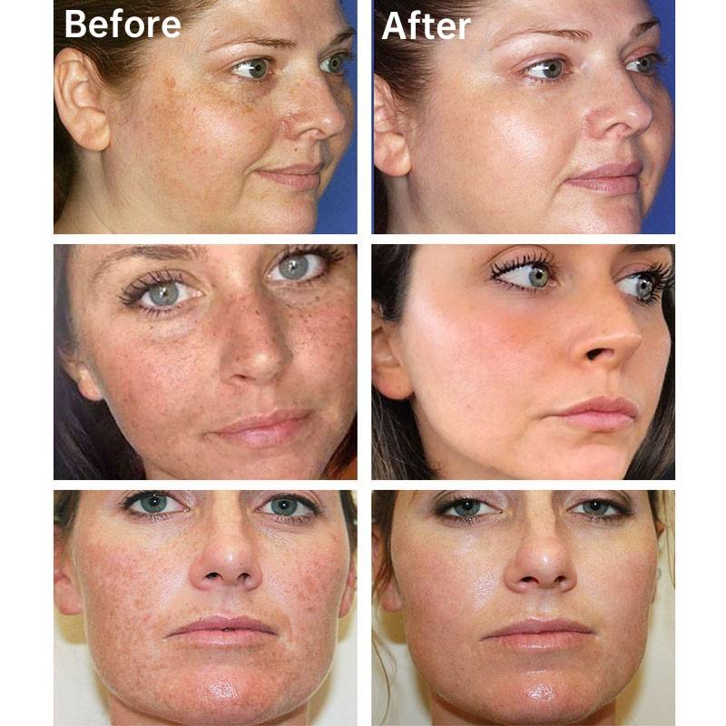 Kem Trị Nám Hiệu Quả Kem Tàn Nhang Trắng Da Xóa Nám Kem Xóa Vết Thâm Melanin Tẩy Nám Làm Sáng Da Chống Lão Hóa Làm Sáng Da AubessDS