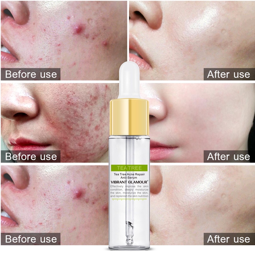 Serum Hỗ trợ giảm mụn VIBRANT GLAMOUR Chiết Xuất Tràm Trà Hiệu Quả T4N7