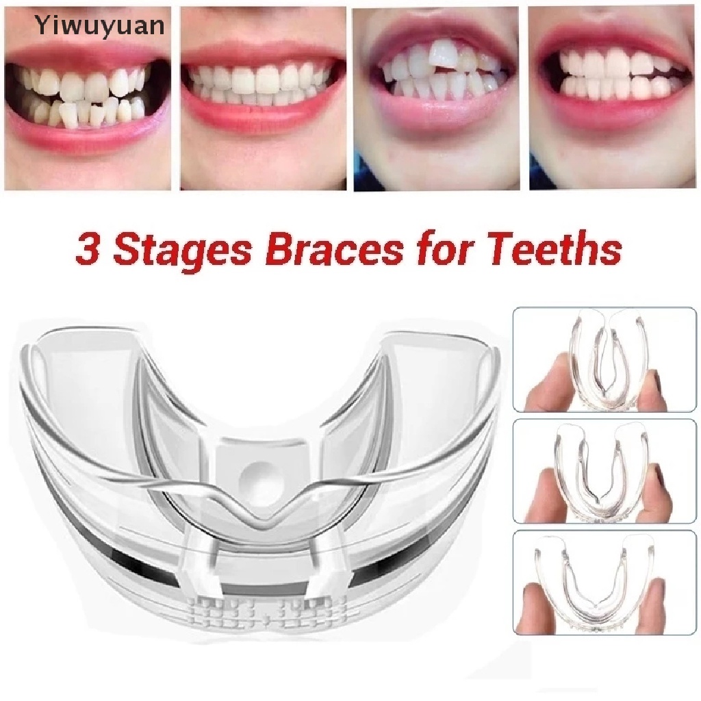 &lt; Yiwuyuan &gt; Đai Nẹp Chỉnh Hình Răng Chăm Sóc Răng Miệng