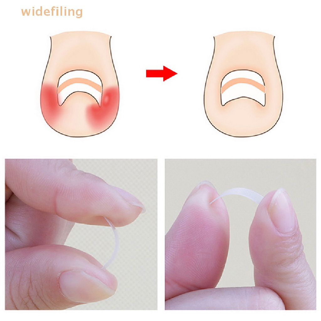 Set 120 Miếng Dán Chỉnh Sửa Móng Chân Mọc Ngược Tiện Dụng