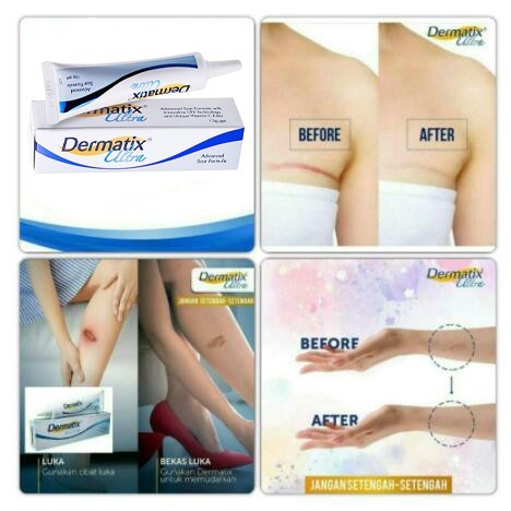 Kem giảm sẹo EELHOE Dermatix 15g hỗ trợ giảm sẹo mụn phục hồi