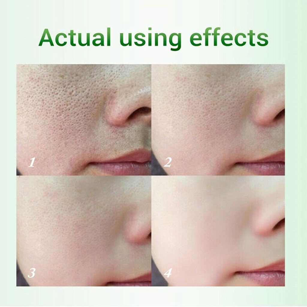 Kem Loại Bỏ Mụn Đầu Đen Se Khít Lỗ Chân Lông L9X6