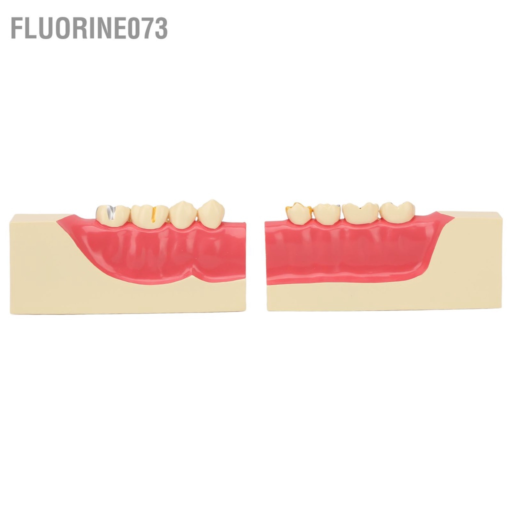 Fluorine073 Mô hình răng sau bên phải Độ phóng đại gấp 2 lần hiển thị nhựa có thể tháo rời