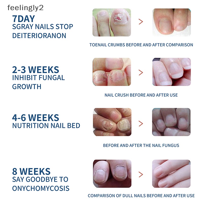 Bộ 32 Miếng Dán Chỉnh Sửa Chữa Móng Chân An Toàn