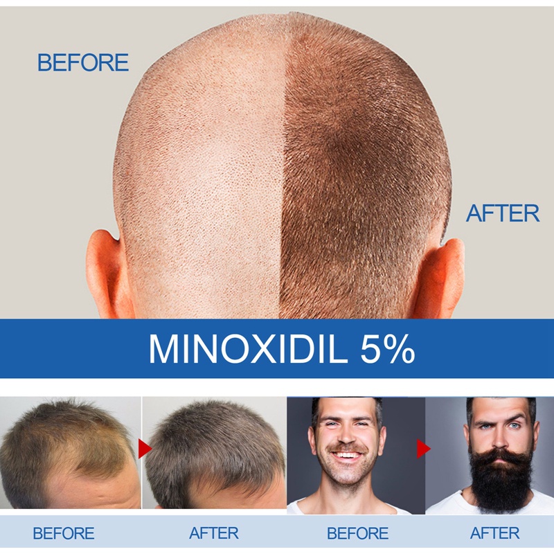 Tinh Chất Kích Thích Mọc Tóc Minoxidil 5% Chống Rụng Tóc Cho Nam Giới