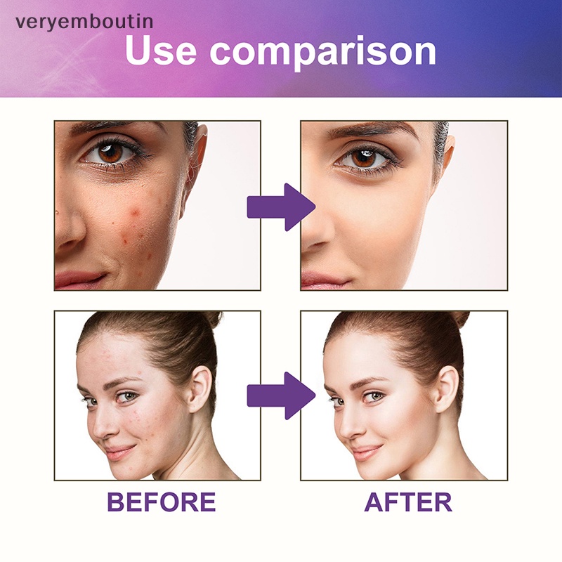 Hộp 144 Miếng Dán Hỗ Trợ Giảm Mụn Chống Thấm Nước