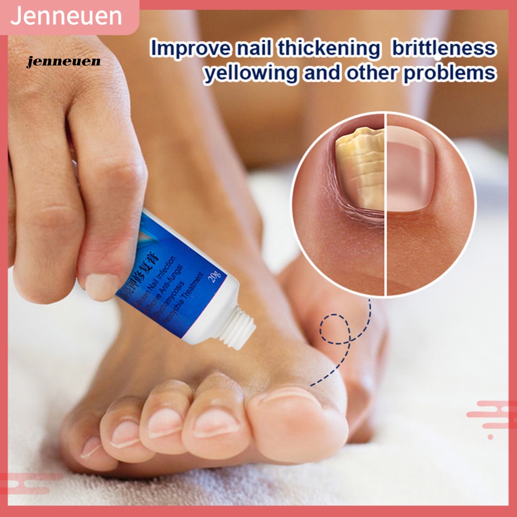 Kem Hỗ trợ giảm nấm Móng Chân 20g Tiện Dụng Chất Lượng Cao