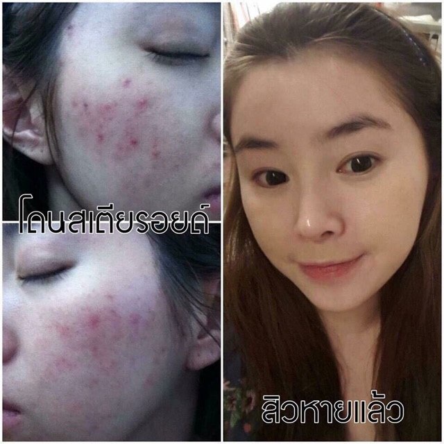 Kem nghệ tươi giảm ngăn ngừa s.ẹo mụn Q’care White Thái Lan