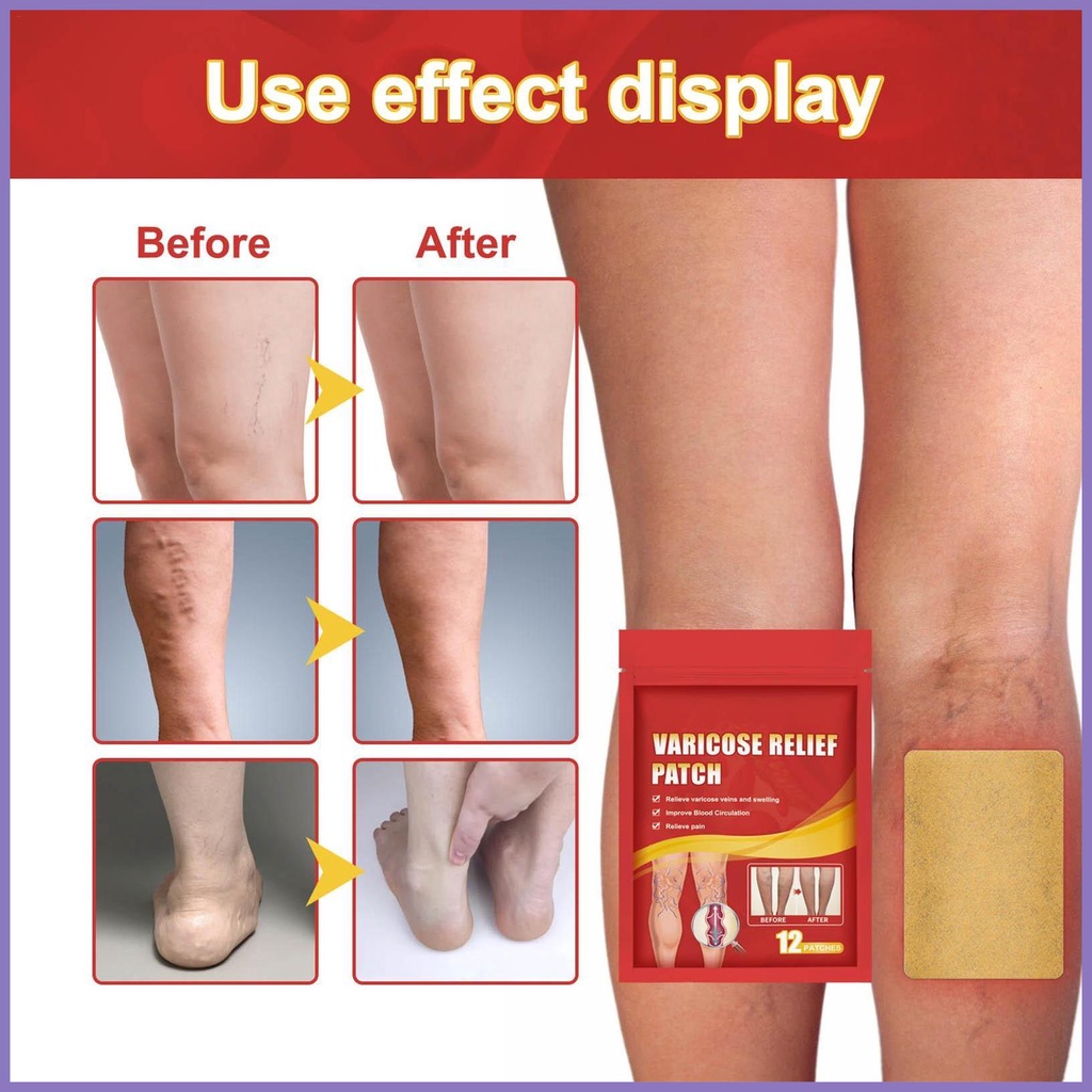Bộ 12 Miếng Dán Giảm Giãn Tĩnh Mạch Cho Nam Nữ nota2vn