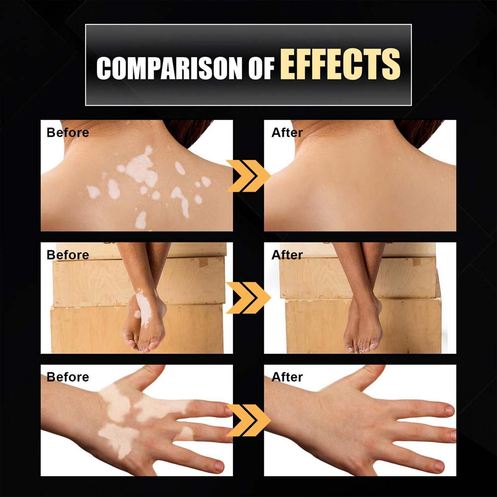 Best Vitiligo Removal Relief Spray Vitiligo Skin Repair Spray for Skin Care New