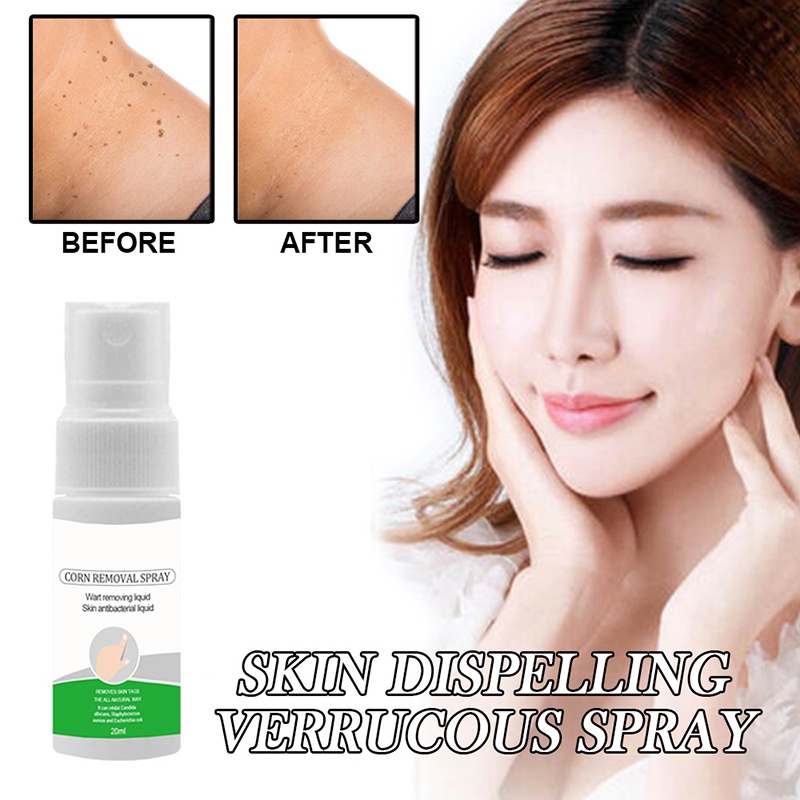 Xịt Tẩy Mụn Thịt Dư Trên Cơ Thể 0.7 oz Tại Nhà