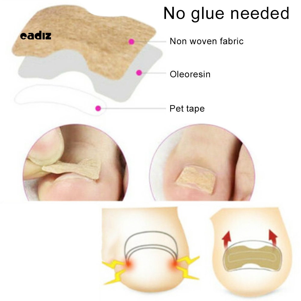 Set 50 Miếng Dán Chỉnh Sửa Móng Chân Mọc Ngược Tiện Dụng