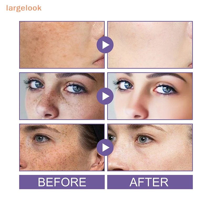 Cây Lăn Loại Bỏ Đốm Đen Làm Sáng Da Mặt 10ml