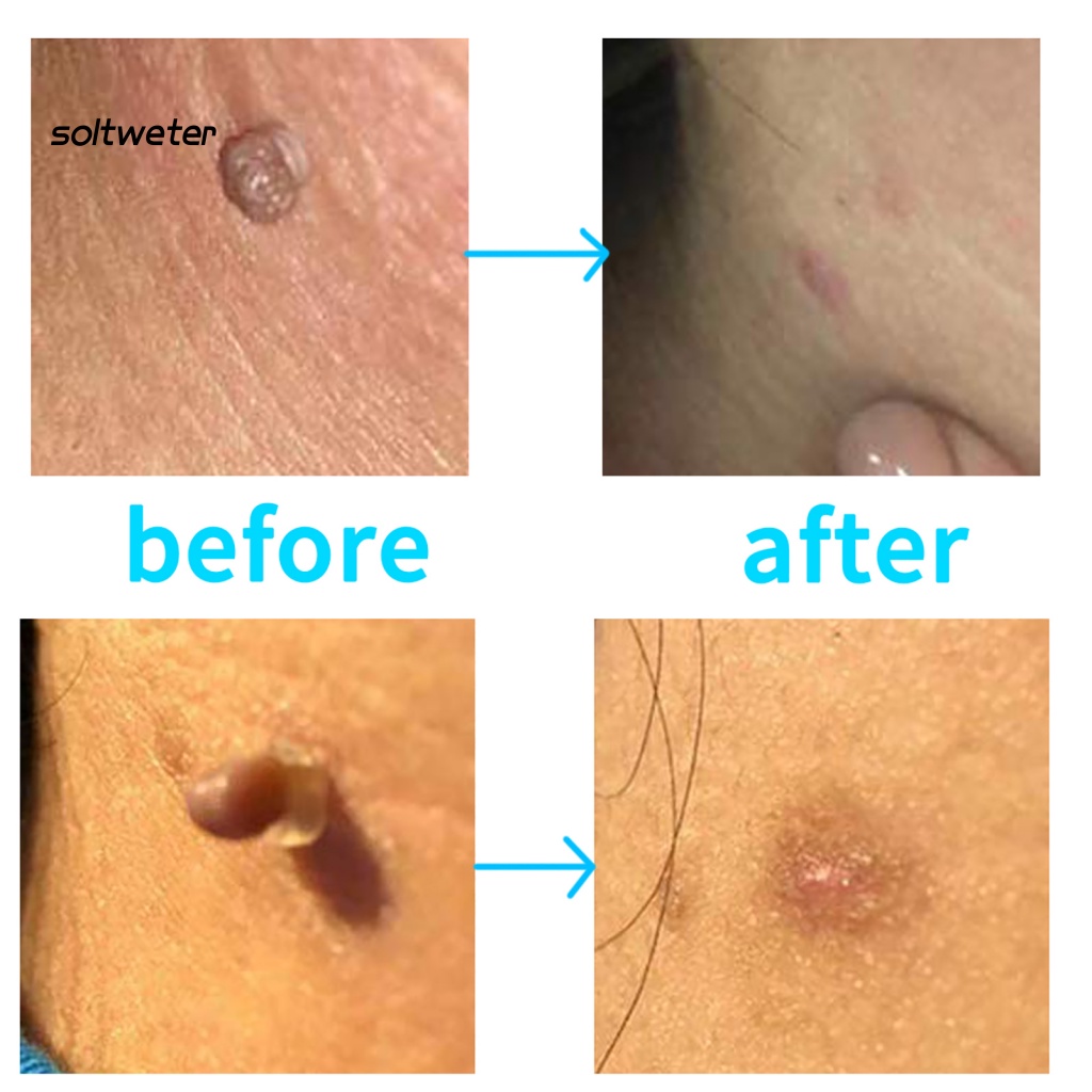 Bộ 10 / 20 / 30 / 50 Dụng Cụ Làm Sạch Mụn Cóc Bằng ABS Tiện Dụng