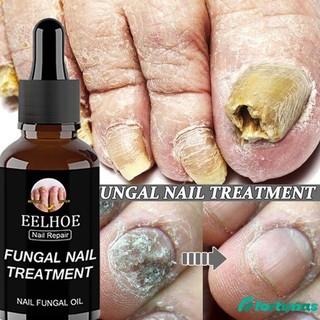 Tinh chất bôi móng JULYSTAR eelhoe phục hồi giảm nấm 50ml