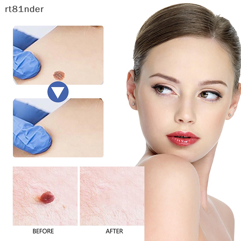 Rt 1 Dụng Cụ Kẹp Nhỏ Bằng Đồng Loại Bỏ Mụn Thịt / Hình Xăm