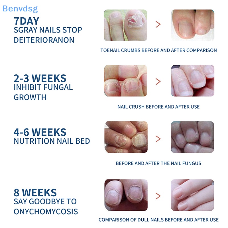 Bộ 32 Miếng Dán Chỉnh Sửa Móng Chân An Toàn