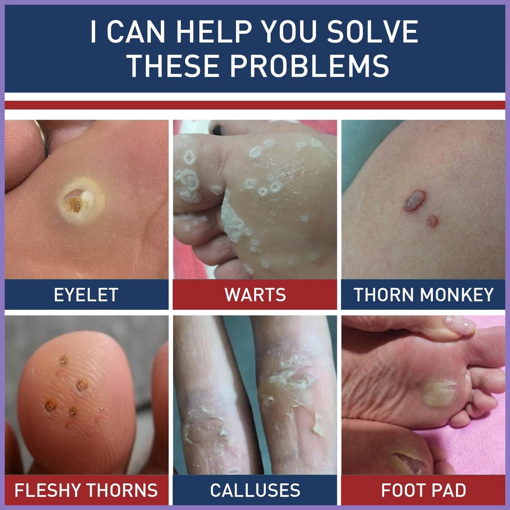 Hộp 24 Miếng Dán Lột Da Chết Chăm Sóc Bàn Chân nota2vn