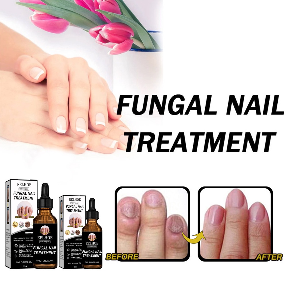 Tinh chất giảm nấm móng JULYSTAR Paronychia 50ml