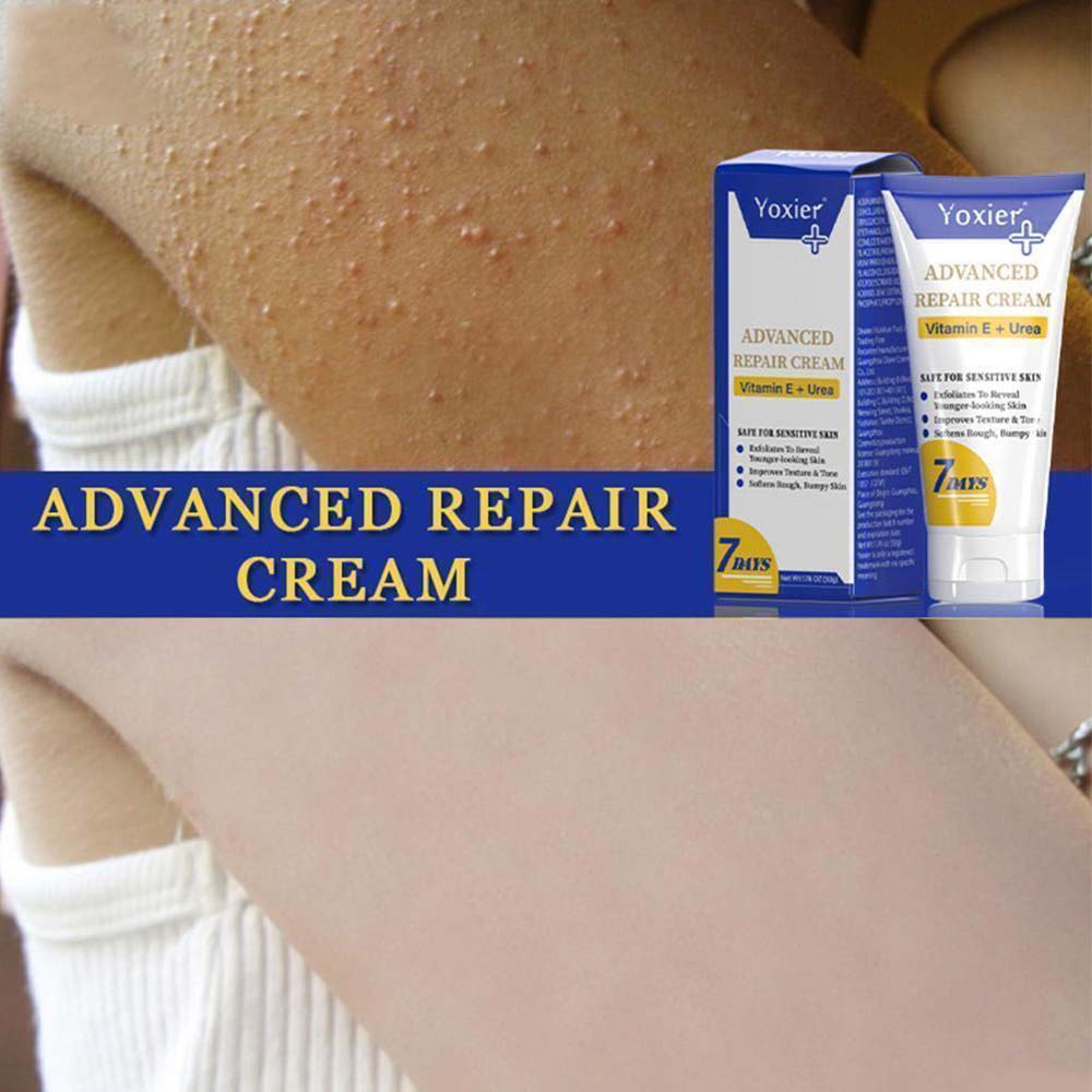 Yoxier Advanced Moisturizing Repair Cream deeply moisturizes the skin and treats itching keratosis