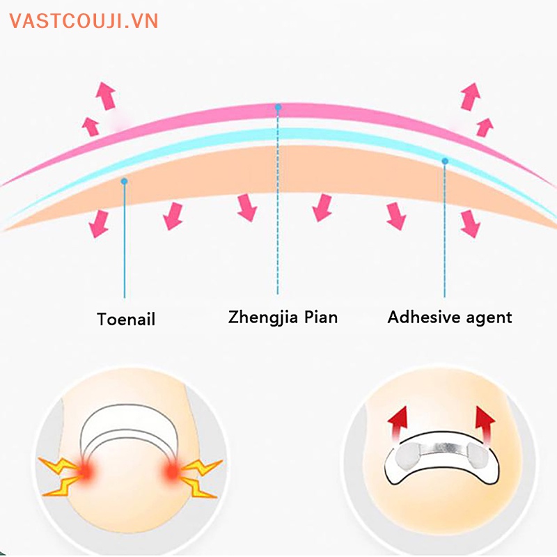 Kẹp Co Giãn Chỉnh Sửa Móng Chân Bị Cong Vnstji