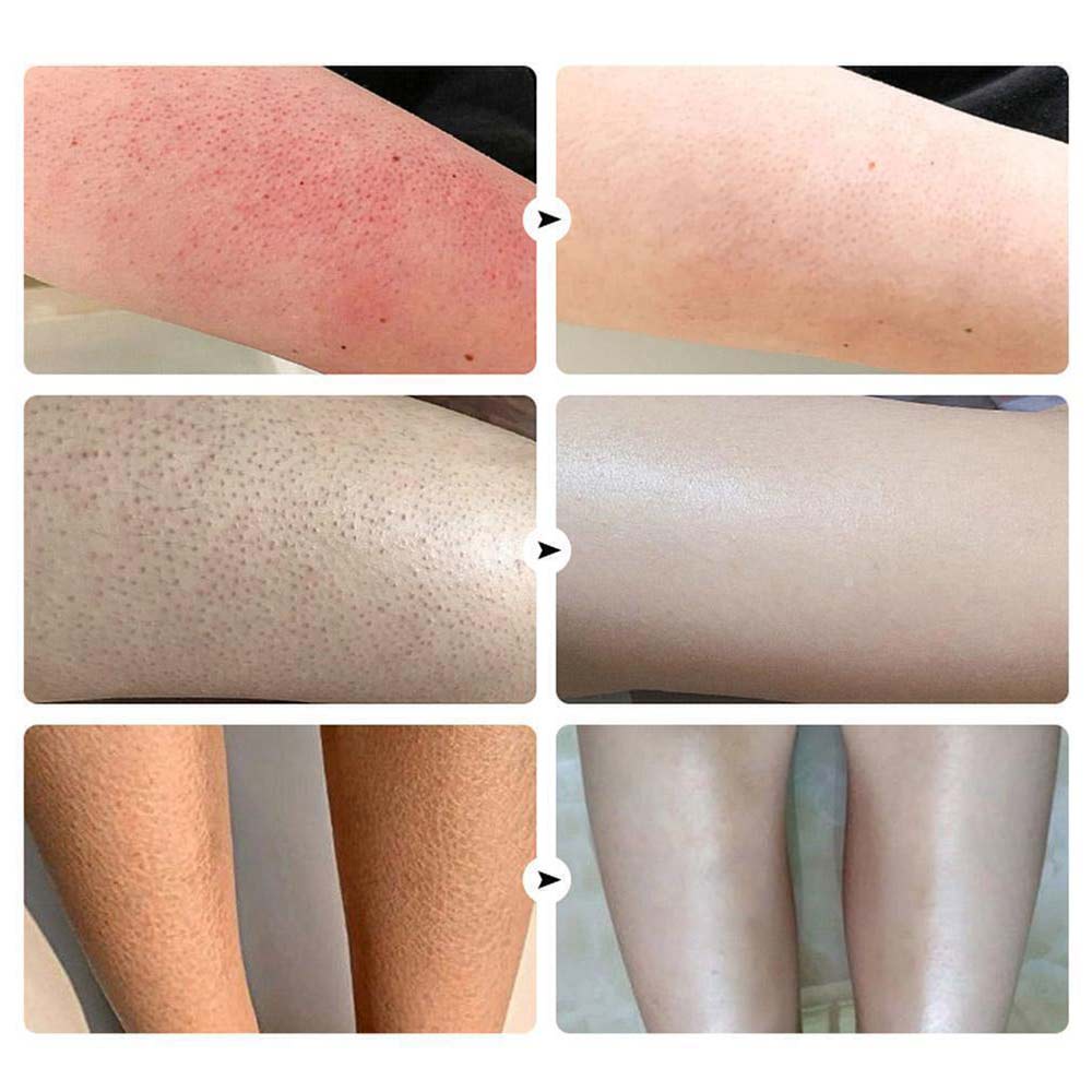 Yoxier Advanced Moisturizing Repair Cream deeply moisturizes the skin and treats itching keratosis