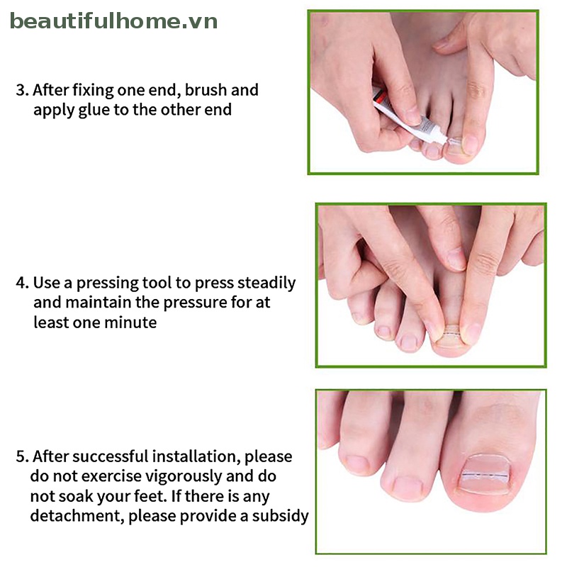 Set 10 Kẹp Cố Định Móng Chân Tiện Dụng Chất Lượng Cao