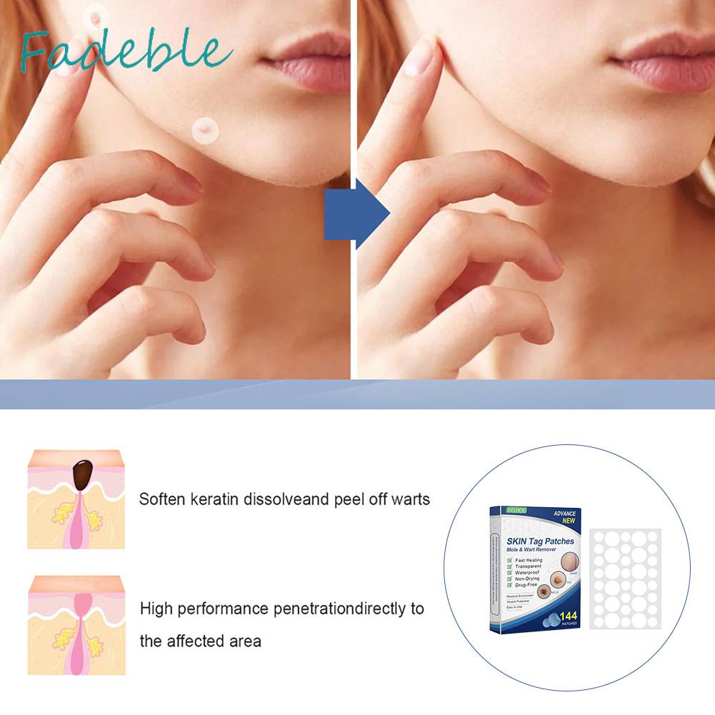 Set 144 Miếng Dán Trị Mụn Nhỏ Gọn Dễ Sử Dụng